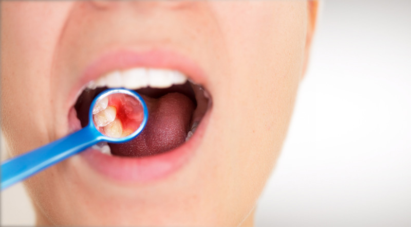 Open human mouth during oral checkup at the dentist