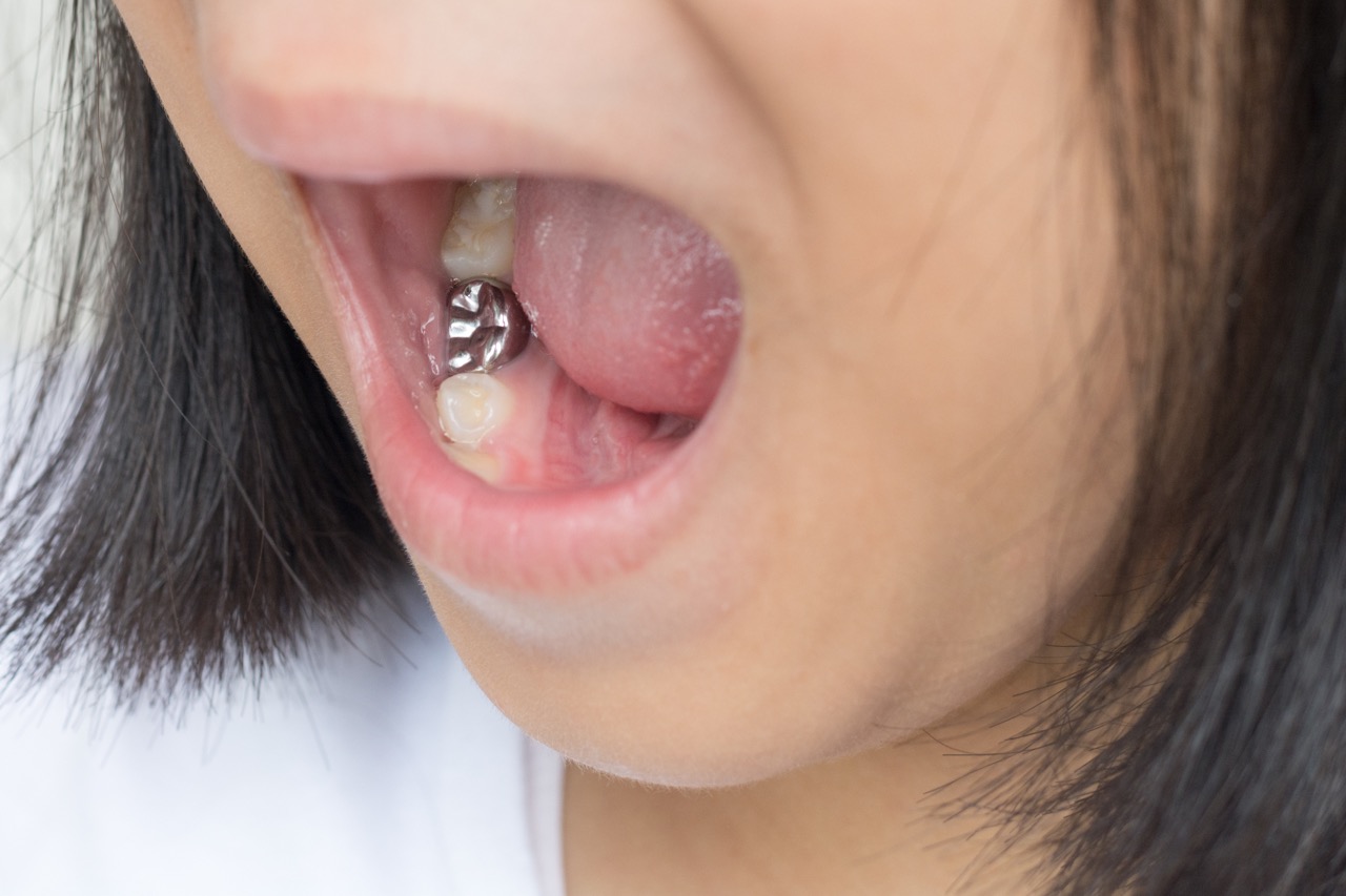 girl with silver dental filling