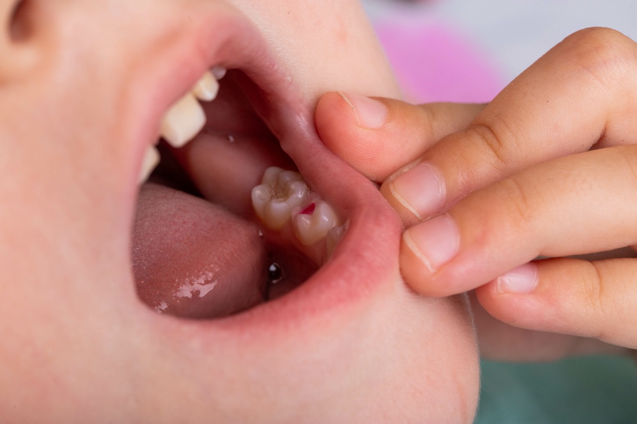 child checking fillings in their baby teeth